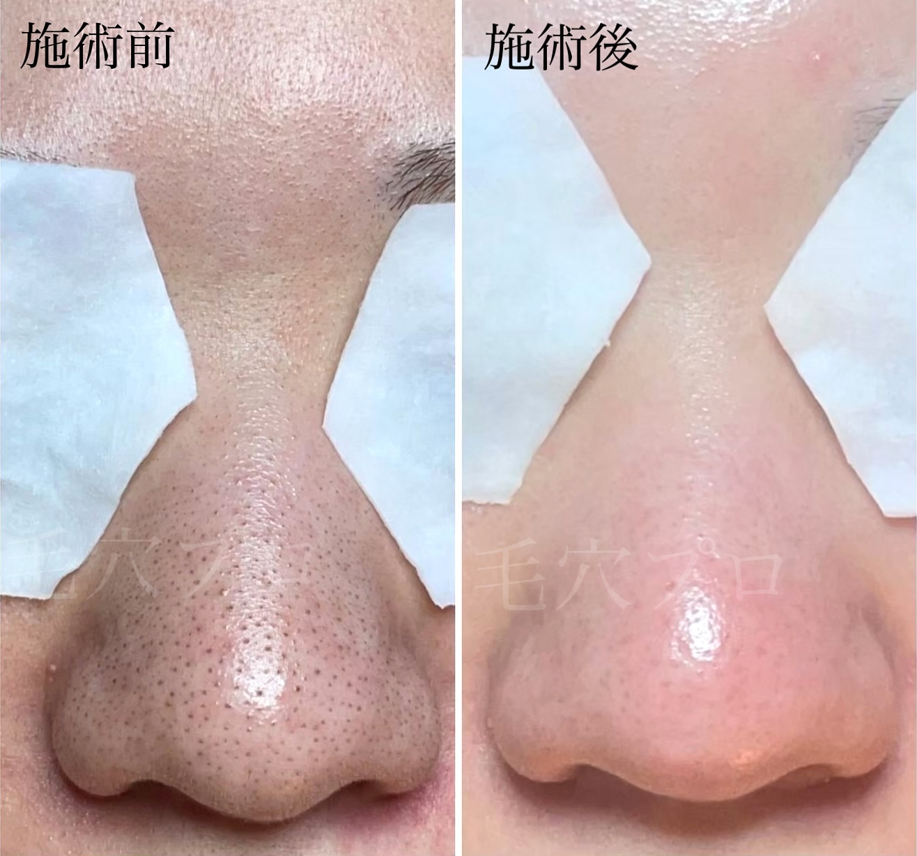 施術前、施術後の比較写真