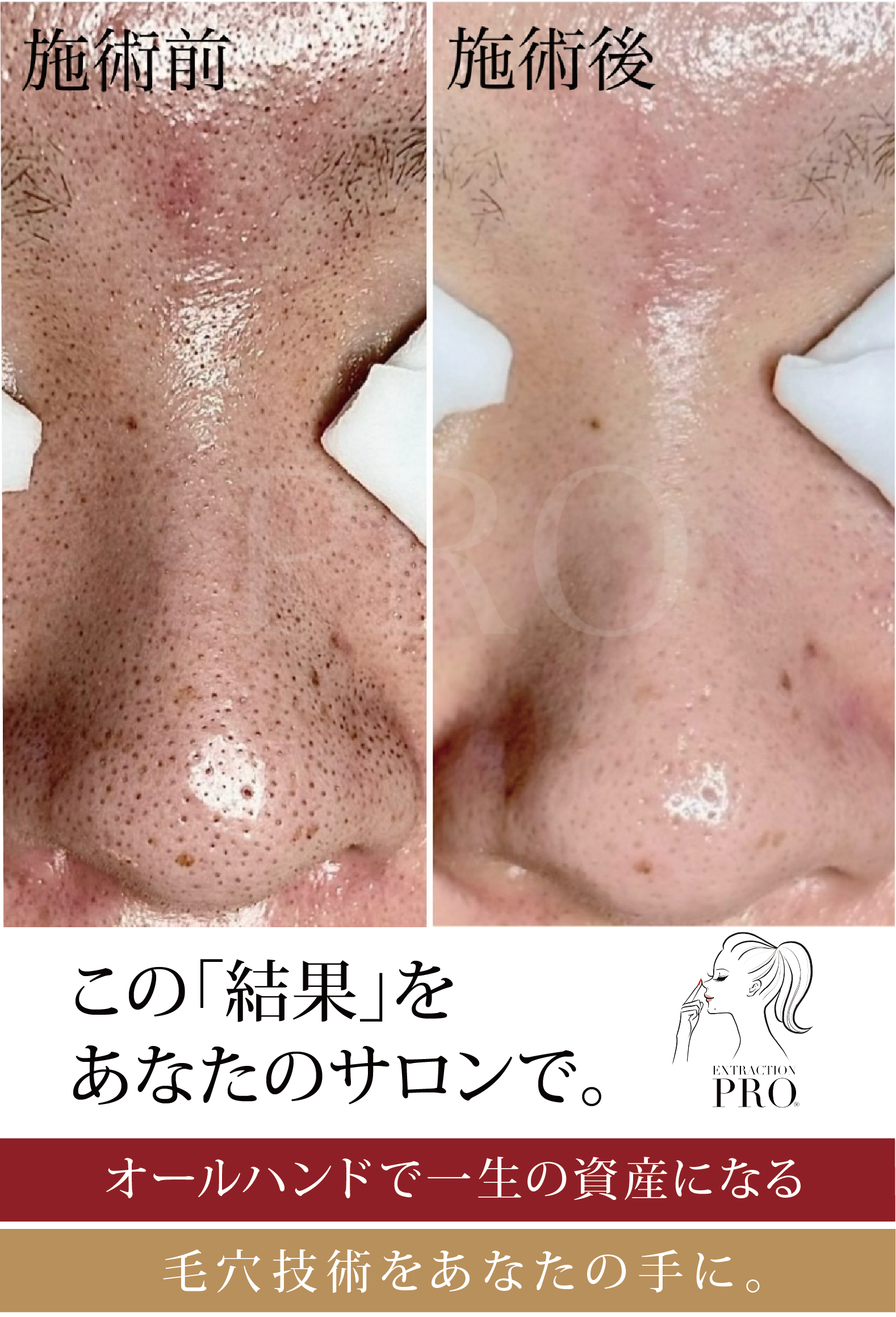 この「結果」をあなたのサロンで。オールハンドで一生の資産になる。毛穴技術をあなたの手に。